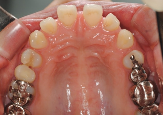 歯の隙間が空いている空隙歯列