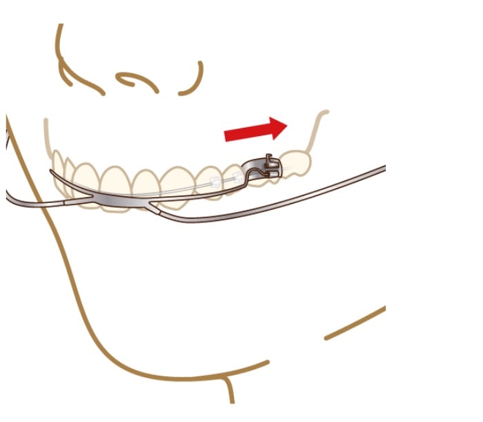 奥歯を後ろに移動させるヘッドギアという矯正装置