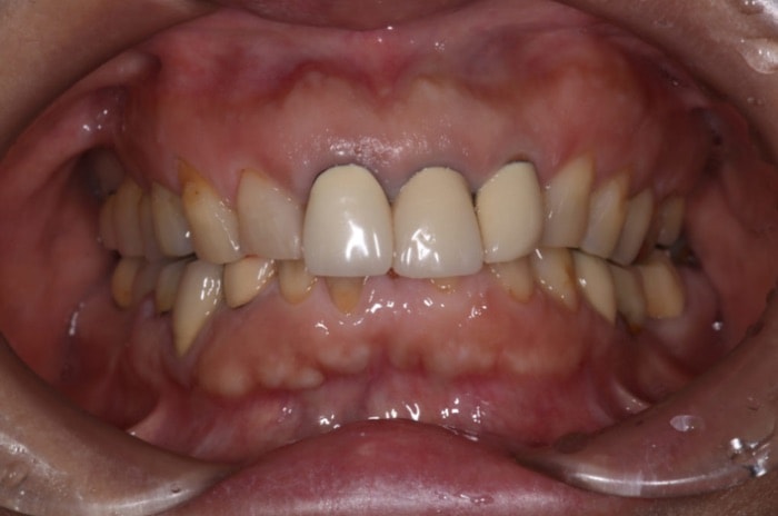 セラミック矯正装置による治療期間